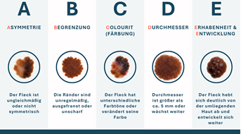 abcde-hautgesundheit-muttermale-haut-hautvera-nderungen-vorsorge-gesundheit-vh