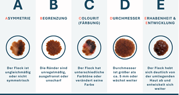 abcde-hautgesundheit-muttermale-haut-hautvera-nderungen-vorsorge-gesundheit-vh