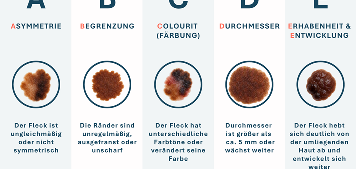 abcde-hautgesundheit-muttermale-haut-hautvera-nderungen-vorsorge-gesundheit-vh